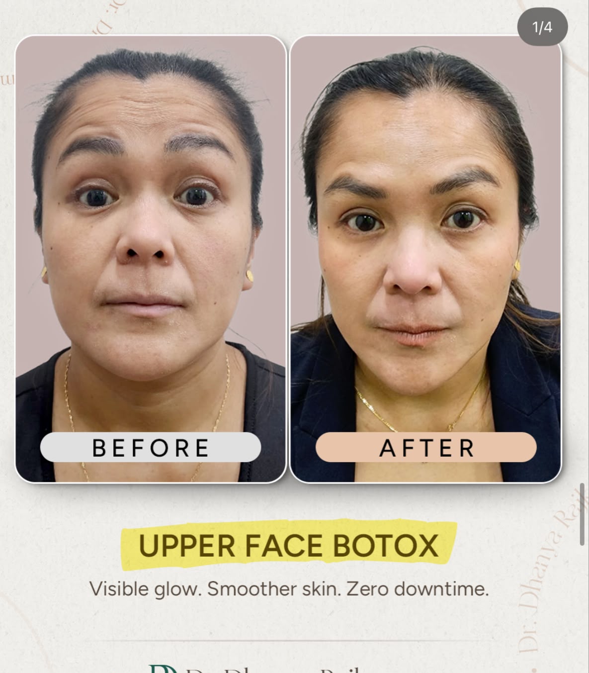 Upper Face Botox